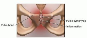 Osteitis Pubis: Causes & Treatment Insights